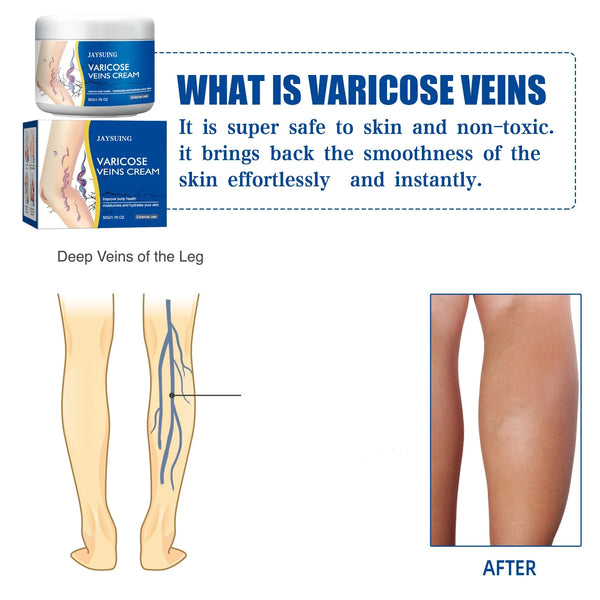 Jaysuing-Veins-Treatment-Creams-Soothing-Painness-Eliminate-Vasculitis-Phlebitis-Remove-Spider-Leg-Angiitis-Improvement-Ointment.jpg